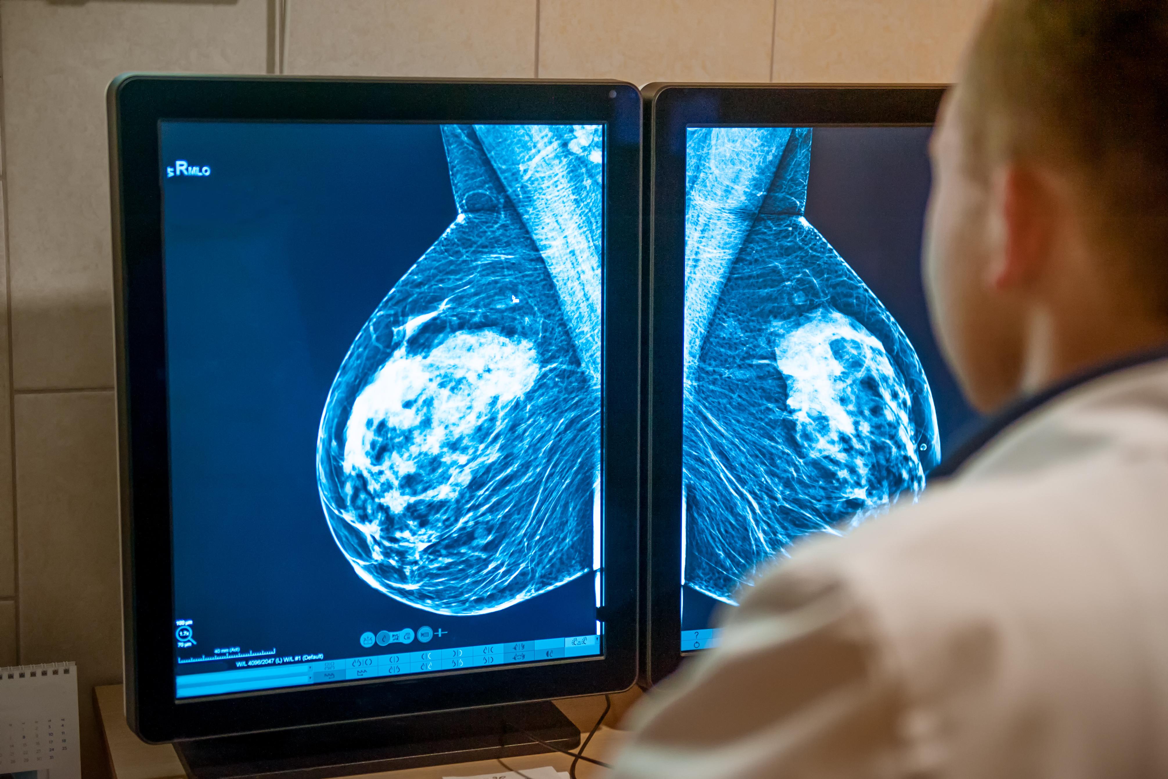 Master project: Uncertainty quantification of a breast cancer detection model for breast cancer screening