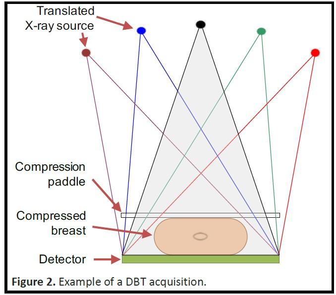 example DBT acquisition